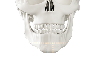 Step 1 intraoral incision with 3D-CT analysis for long jaw surgery
