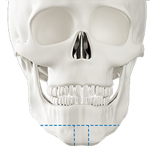 Step 1 intraoral incision with 3D-CT analysis for long jaw surgery