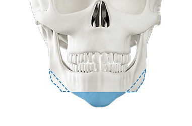 Step 2 individualized osteotomy Y T W M technique for jaw correction