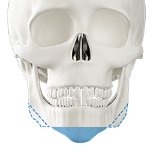 Step 2 individualized osteotomy Y T W M technique for jaw correction