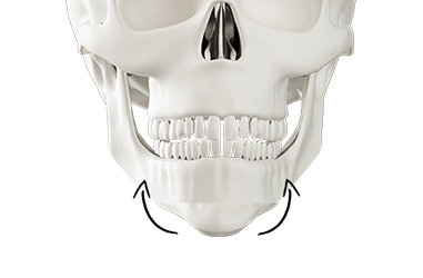 Step 3 muscle fixation after jaw reduction for 3D facial effect