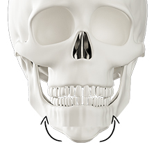 Step 3 muscle fixation after jaw reduction for 3D facial effect