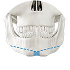 Y osteotomy technique for long jaw surgery at NANA Plastic Surgery