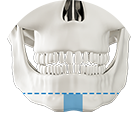 T osteotomy technique for square face with broad front jaw