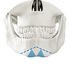 M osteotomy technique for sleek jawline from bottom to front