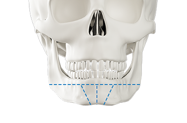 Step 1 intraoral incision for genioplasty bone plate surgery