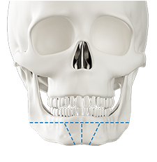 Step 1 intraoral incision for genioplasty bone plate surgery