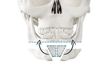 Step 2 bone excision and transplantation for chin lengthening