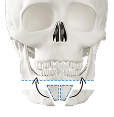 Step 2 bone excision and transplantation for chin lengthening