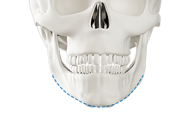 Step 3 final bone excision and fixation for chin surgery