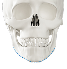 Step 3 final bone excision and fixation for chin surgery