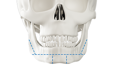 Step 1 intraoral incision for square chin bone transplant surgery