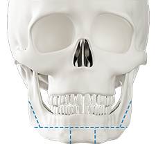Step 1 intraoral incision for square chin bone transplant surgery