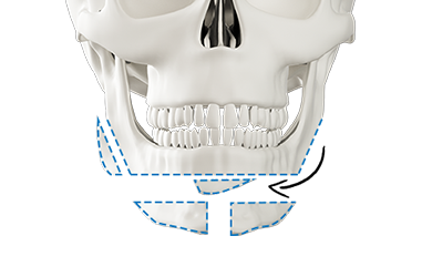 Step 2 excision and transplantation of square chin bones