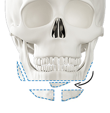 Step 2 excision and transplantation of square chin bones