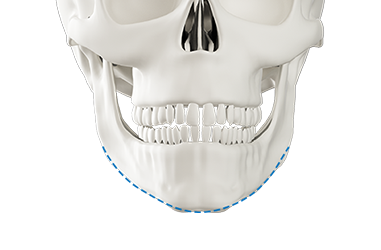 Step 3 final bone excision and securing for chin lengthening