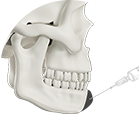Fat grafting and filler chin enhancement illustration