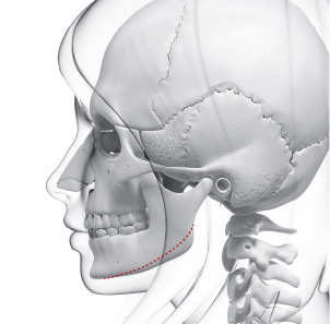 Mini V line surgery step 2 minimal 1-2cm incision behind ear tailored to square jaw position at NANA Korea