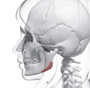 V line surgery technique 2 cortical removal to maximize frontal slimming effect at NANA Korea