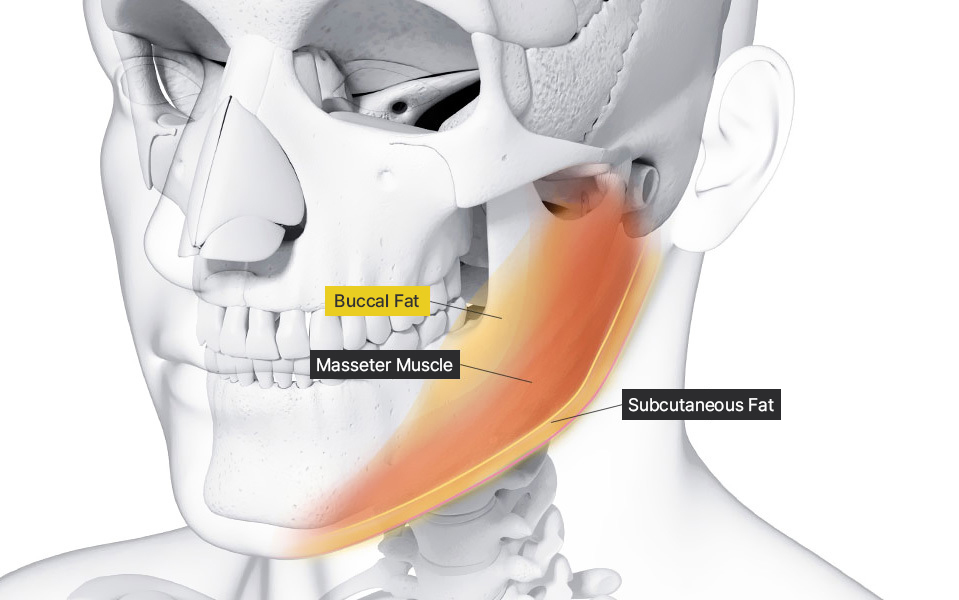 Before and after buccal fat removal for slimmer cheeks at NANA Plastic Surgery Korea