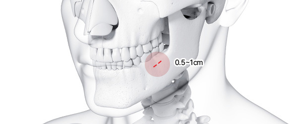 Step 1 intraoral incision of 0.5 to 1cm for buccal fat removal at NANA