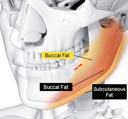 Step 2 selective removal of excess buccal fat through intraoral incision