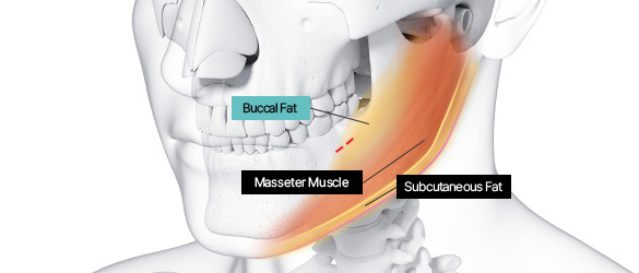 Step 2 selective removal of excess buccal fat through intraoral incision