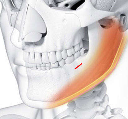 Step 3 intraoral suturing with dissolvable stitches after buccal fat removal