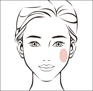 Cheek fat removal for a slimmer and more defined facial contour