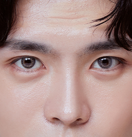 Male eye surgery recommended for men using forehead to lift eyes causing forehead wrinkles at NANA