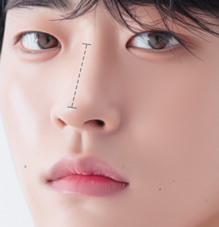 Male rhinoplasty recommended for men whose nose looks low and short compared to face at NANA Korea