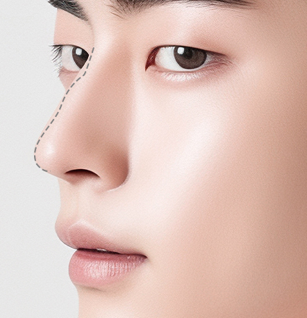 Male rhinoplasty recommended for men with pronounced hump and drooping nose tip at NANA Korea