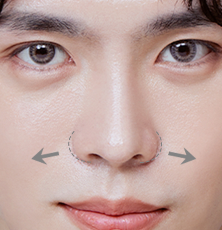 Male rhinoplasty recommended for men with wide and flat nasal tip at NANA Plastic Surgery Korea