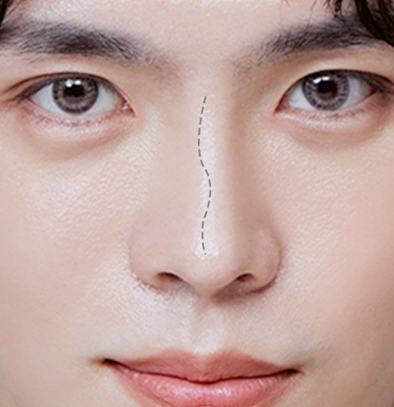 Male rhinoplasty recommended for men with crooked nose due to injury at NANA Korea
