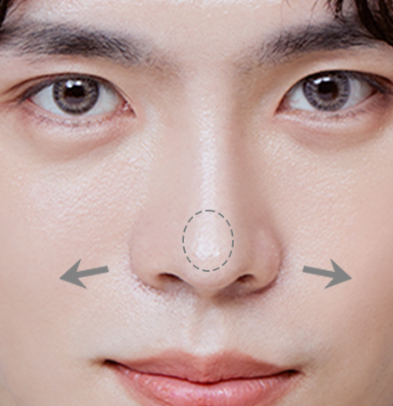 Male rhinoplasty recommended for men with excess tissue and bulbous nose shape at NANA Korea