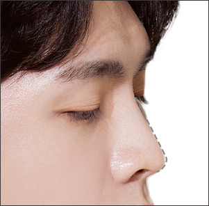 Low nose augmentation rhinoplasty raising nasal bridge to match facial features at NANA Korea