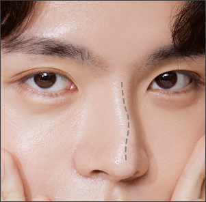 Crooked nose correction addressing both visible misalignment and internal nasal congestion at NANA Korea