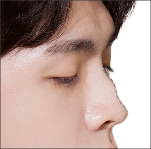 Hump nose correction removing nasal bridge protrusion caused by internal bone structure at NANA Korea