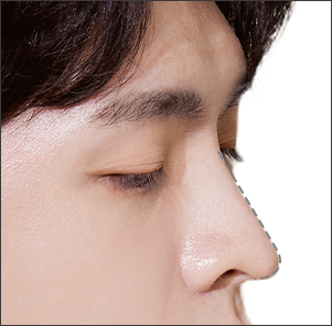 Hooked nose correction lifting drooping nasal tip for a balanced masculine profile at NANA Korea