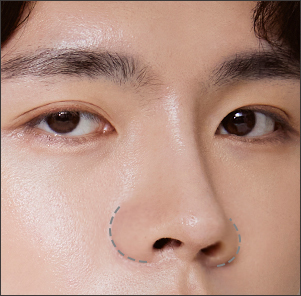 Bulbous nose correction reshaping cartilage and removing fat for a refined nasal tip at NANA Korea