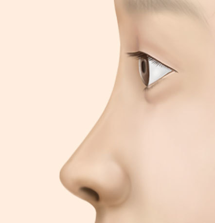 flat nose case suitable for rhinoplasty surgery