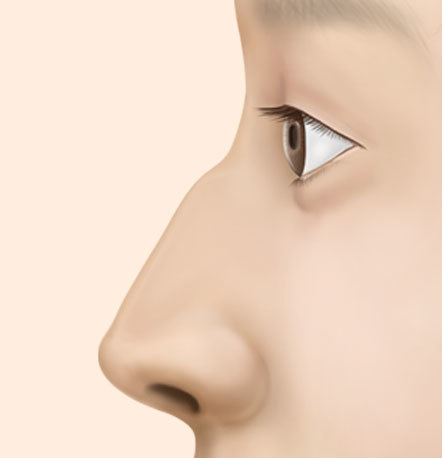 hump nose correction rhinoplasty case
