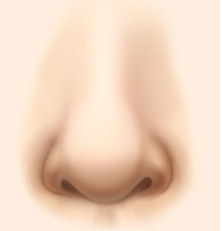 bulbous nose tip rhinoplasty surgery