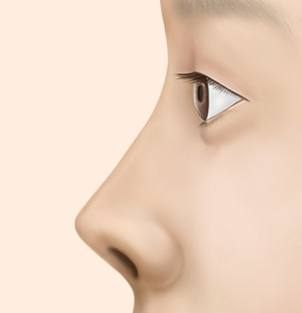 short nose lengthening rhinoplasty surgery