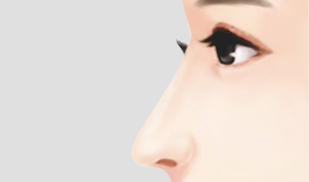 long nose correction rhinoplasty surgery