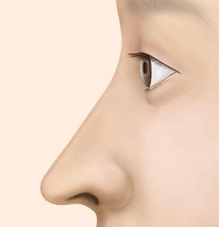 arrowhead nose rhinoplasty correction