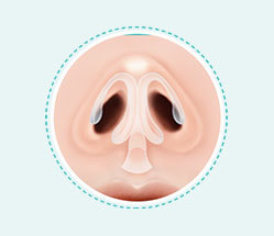 CT scan evaluation of nasal deviation and septal structure