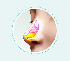 3D CT analysis of nasal bone size and shape before rhinoplasty