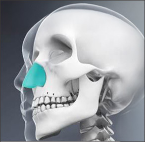 selection of customized nasal implants for rhinoplasty