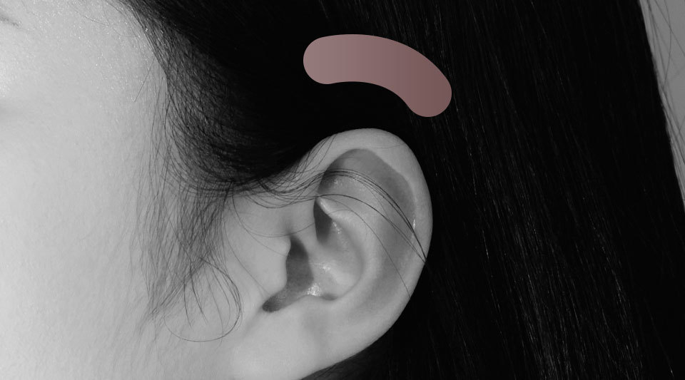 Autologous tissue rhinoplasty case photo 5 at NANA Plastic Surgery Korea